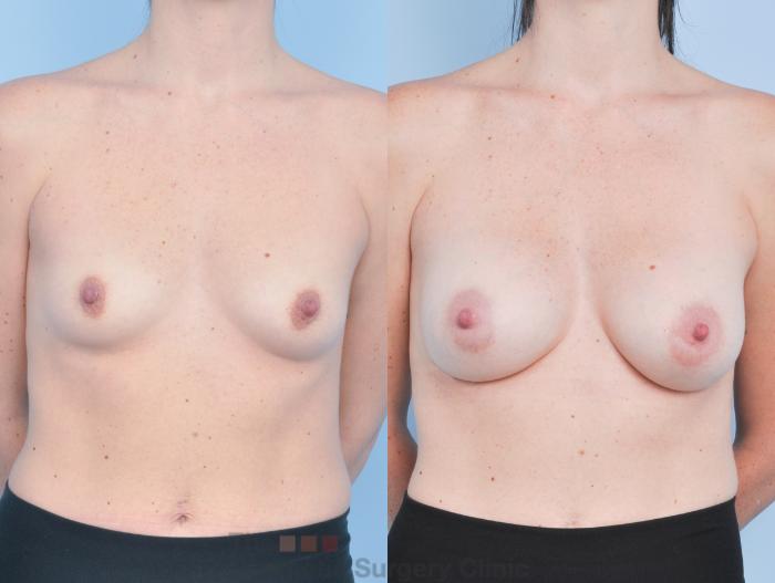 Before & After Breast Augmentation Case 919 Front View in Waterloo, Ontario