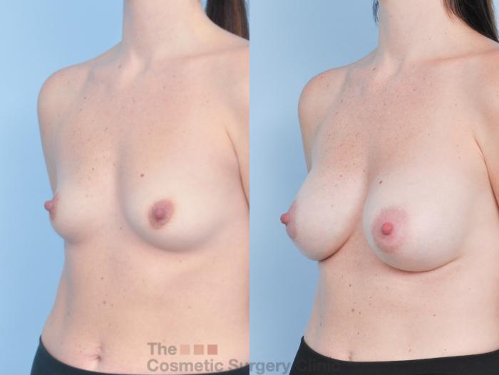 Before & After Breast Augmentation Case 919 Left Oblique View in Waterloo, Ontario