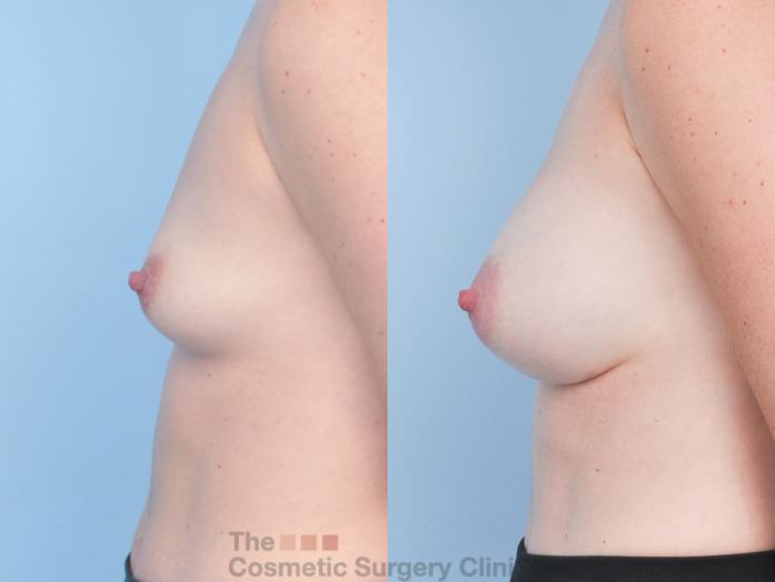 Before & After Breast Augmentation Case 919 Left Side View in Waterloo, Ontario