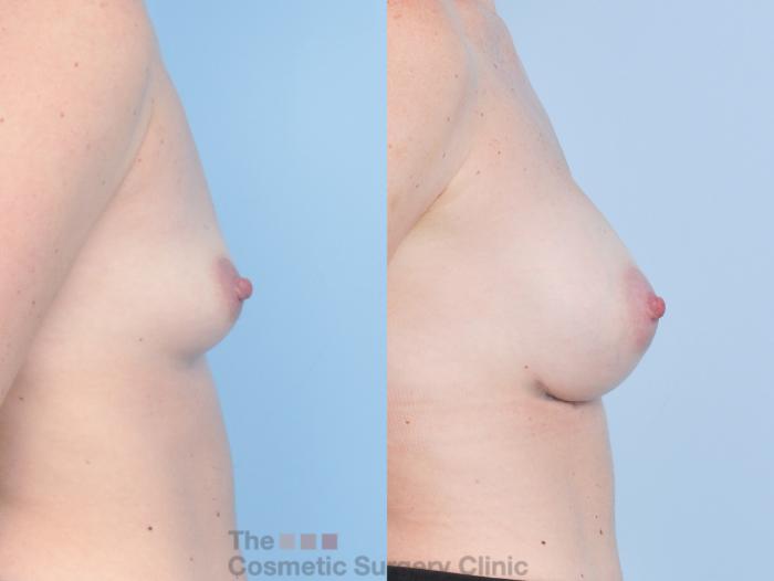Before & After Breast Augmentation Case 919 Right Side View in Waterloo, Ontario