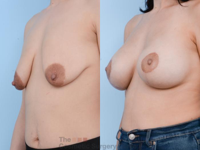 Before & After Breast Augmentation plus Mastopexy (Breast Lift) Case 318 View #2 View in Waterloo, Ontario