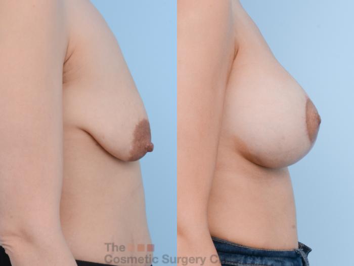 Before & After Breast Augmentation plus Mastopexy (Breast Lift) Case 318 View #4 View in Waterloo, Ontario
