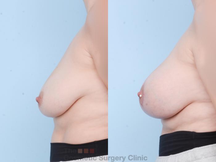 Before & After Breast Augmentation plus Mastopexy (Breast Lift) Case 770 Left Side View in Waterloo, Ontario