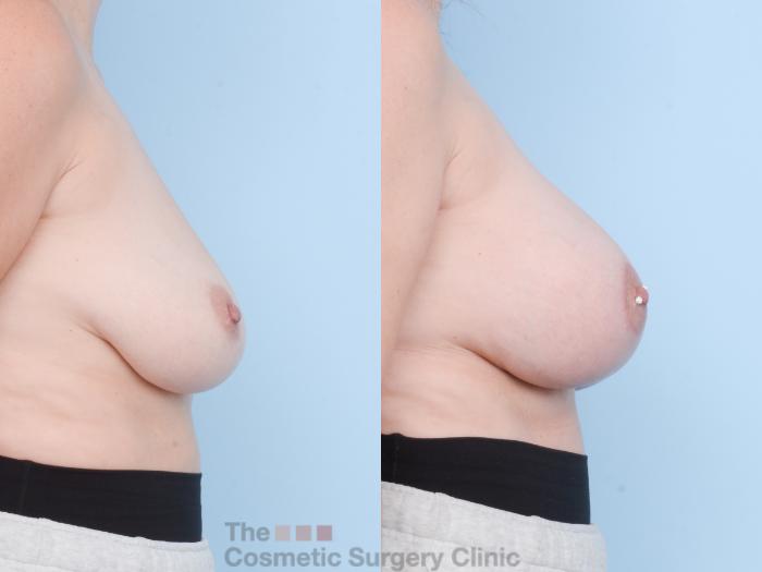Before & After Breast Augmentation plus Mastopexy (Breast Lift) Case 770 Right Side View in Waterloo, Ontario