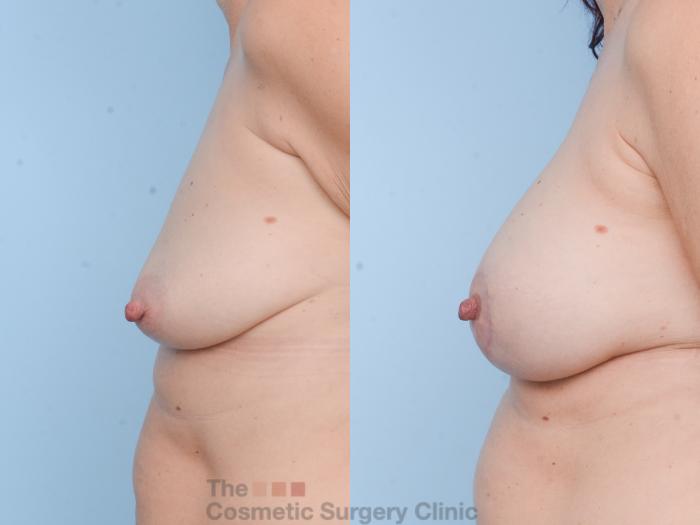 Before & After Breast Augmentation plus Mastopexy (Breast Lift) Case 812 Left Side View in Waterloo, Ontario