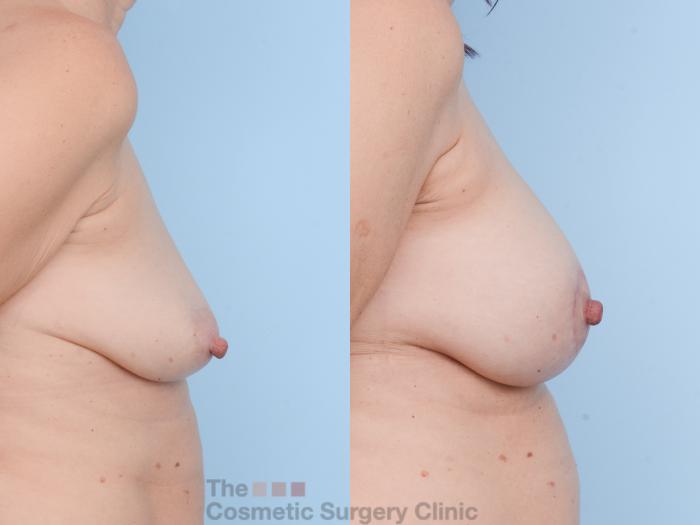 Before & After Breast Augmentation plus Mastopexy (Breast Lift) Case 812 Right Side View in Waterloo, Ontario