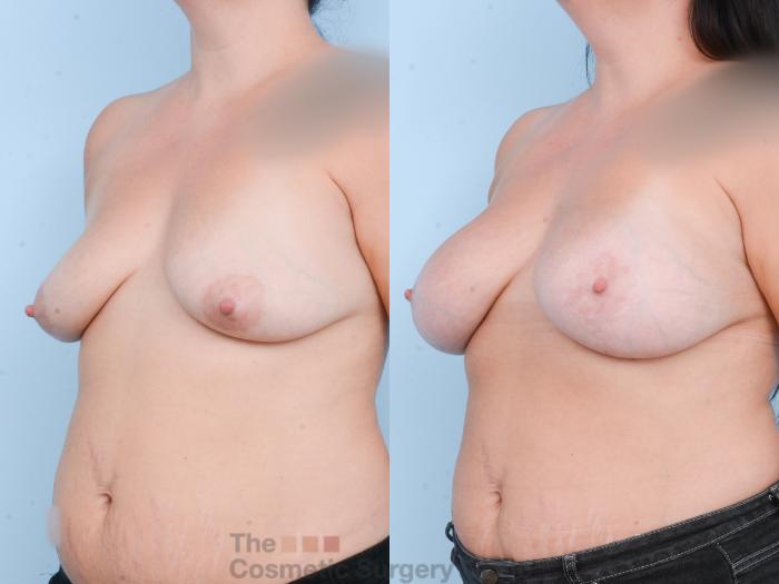 Before & After Breast Augmentation plus Mastopexy (Breast Lift) Case 814 Left Oblique View in Waterloo, Ontario