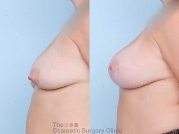 Before & After Breast Augmentation plus Mastopexy (Breast Lift) Case 814 Left Side View in Waterloo, Ontario