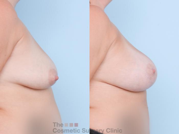 Before & After Breast Augmentation plus Mastopexy (Breast Lift) Case 814 Right Side View in Waterloo, Ontario