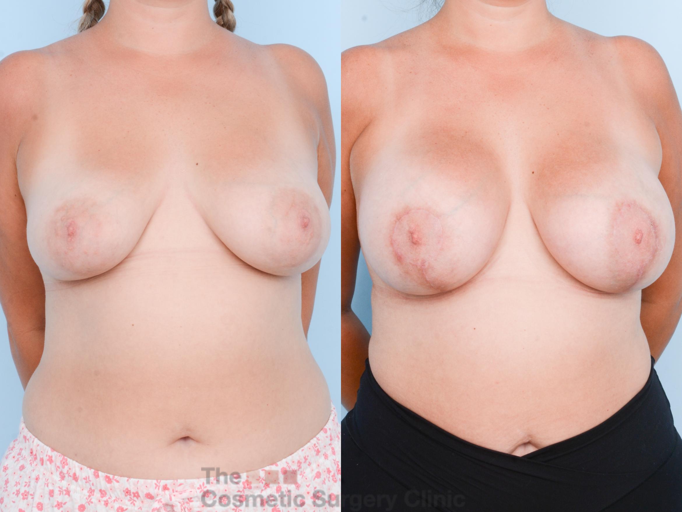 Before & After Breast Augmentation plus Mastopexy (Breast Lift) Case 835 Front View in Waterloo, Ontario