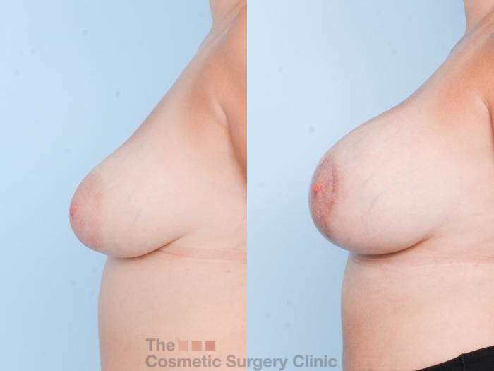 Before & After Breast Augmentation plus Mastopexy (Breast Lift) Case 835 Left Side View in Waterloo, Ontario