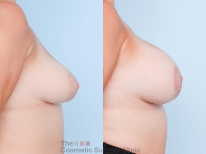 Before & After Breast Augmentation plus Mastopexy (Breast Lift) Case 835 Right Side View in Waterloo, Ontario