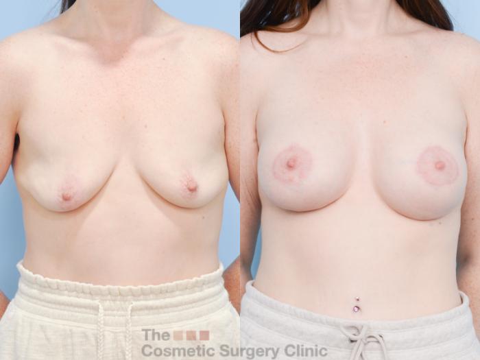 Before & After Breast Augmentation plus Mastopexy (Breast Lift) Case 851 Front View in Waterloo, Ontario