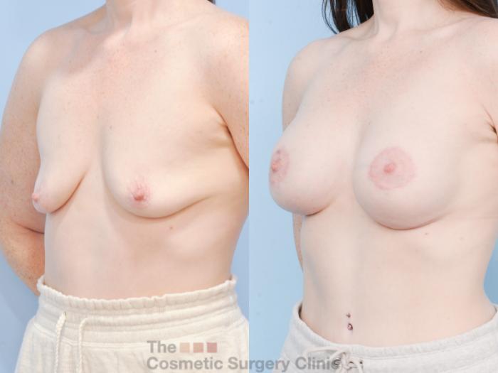 Before & After Breast Augmentation plus Mastopexy (Breast Lift) Case 851 Left Oblique View in Waterloo, Ontario