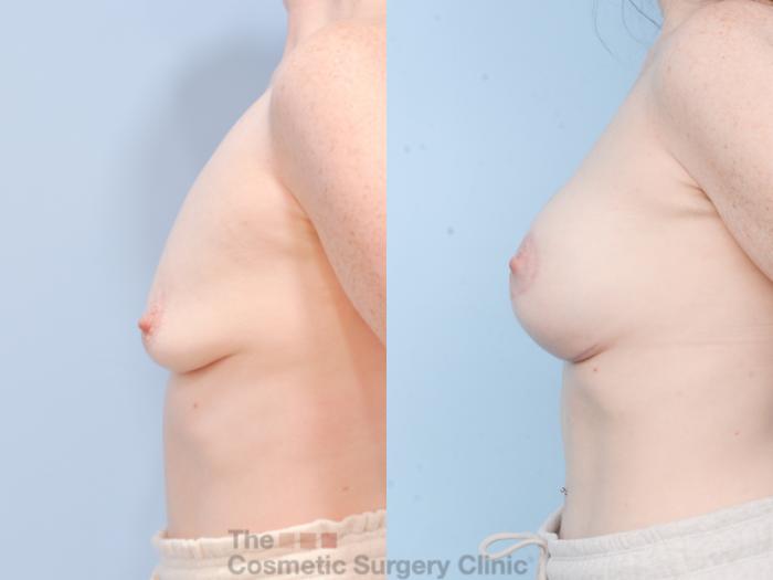 Before & After Breast Augmentation plus Mastopexy (Breast Lift) Case 851 Left Side View in Waterloo, Ontario
