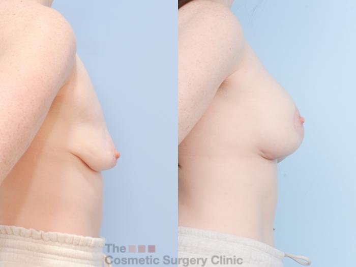 Before & After Breast Augmentation plus Mastopexy (Breast Lift) Case 851 Right Side View in Waterloo, Ontario