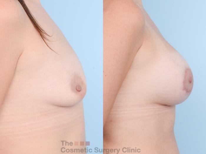 Before & After Breast Augmentation plus Mastopexy (Breast Lift) Case 868 Right Side View in Waterloo, Ontario