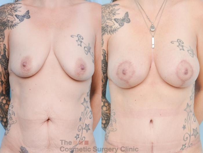 Before & After Breast Augmentation plus Mastopexy (Breast Lift) Case 879 Front View in Waterloo, Ontario
