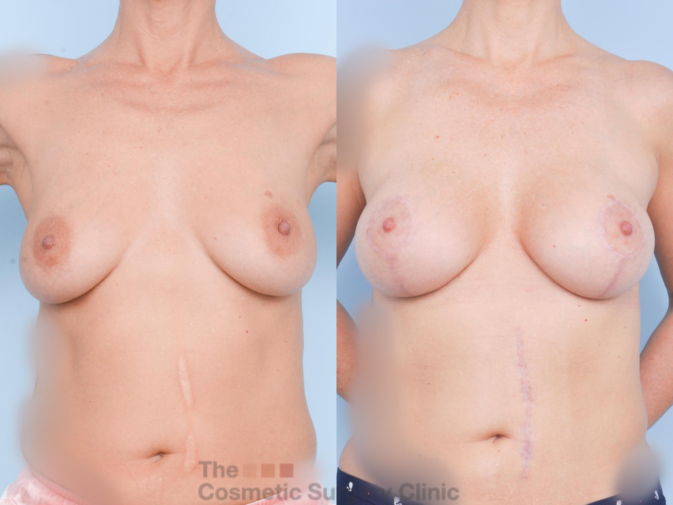 Before & After Breast Augmentation plus Mastopexy (Breast Lift) Case 894 Front View in Waterloo, Ontario