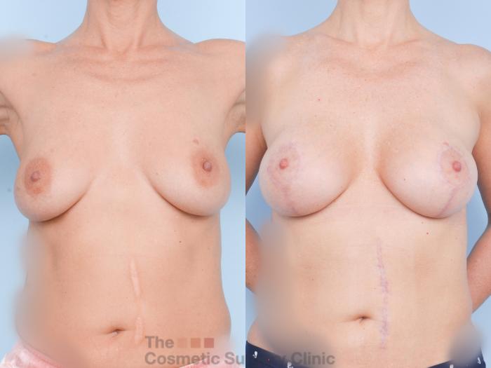 Before & After Breast Augmentation plus Mastopexy (Breast Lift) Case 894 Front View in Waterloo, Ontario