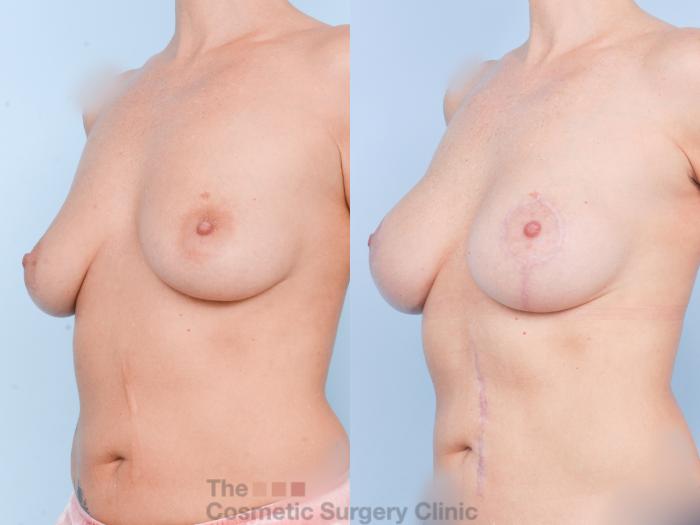 Before & After Breast Augmentation plus Mastopexy (Breast Lift) Case 894 Left Oblique View in Waterloo, Ontario