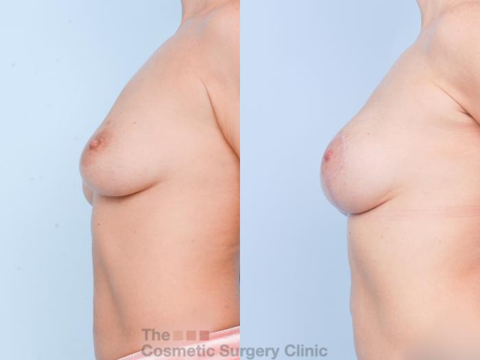 Before & After Breast Augmentation plus Mastopexy (Breast Lift) Case 894 Left Side View in Waterloo, Ontario