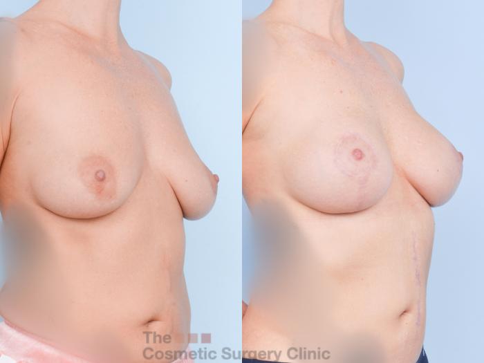 Before & After Breast Augmentation plus Mastopexy (Breast Lift) Case 894 Right Oblique View in Waterloo, Ontario