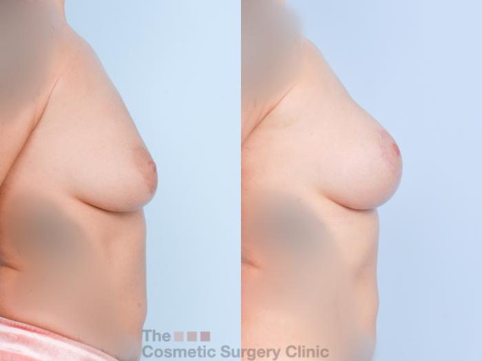 Before & After Breast Augmentation plus Mastopexy (Breast Lift) Case 894 Right Side View in Waterloo, Ontario