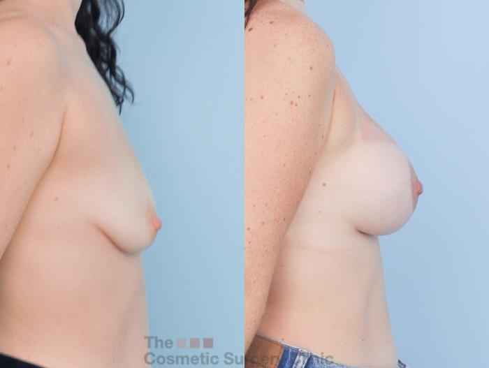Before & After Breast Augmentation plus Mastopexy (Breast Lift) Case 911 Right Side View in Waterloo, Ontario