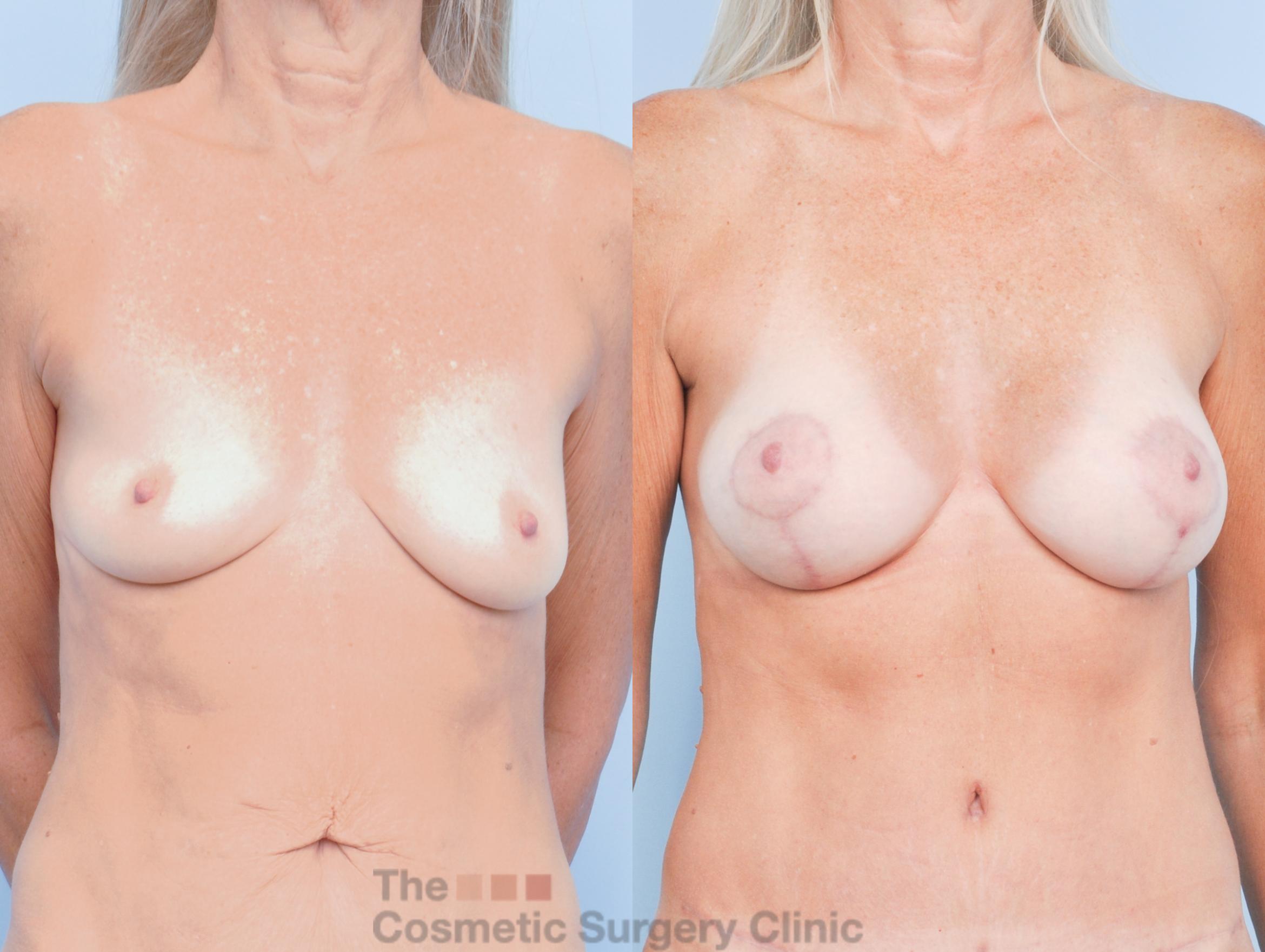 Before & After Breast Augmentation plus Mastopexy (Breast Lift) Case 912 Front View in Waterloo, Ontario