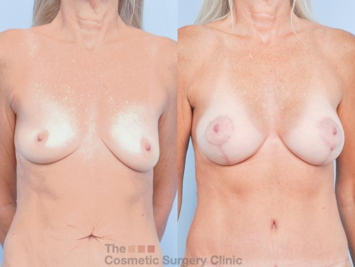 Before & After Breast Augmentation plus Mastopexy (Breast Lift) Case 912 Front View in Waterloo, Ontario