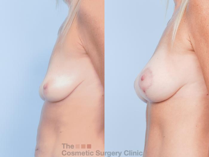Before & After Breast Augmentation plus Mastopexy (Breast Lift) Case 912 Left Side View in Waterloo, Ontario