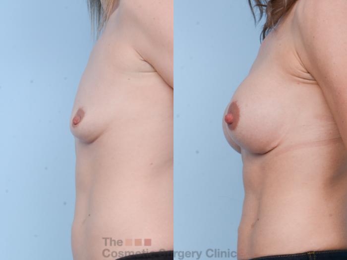 Before & After Breast Augmentation with Fat Grafting Case 502 View #2 View in Waterloo, Ontario