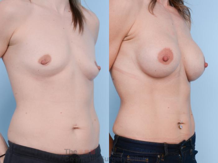Before & After Breast Augmentation with Fat Grafting Case 502 View #4 View in Waterloo, Ontario