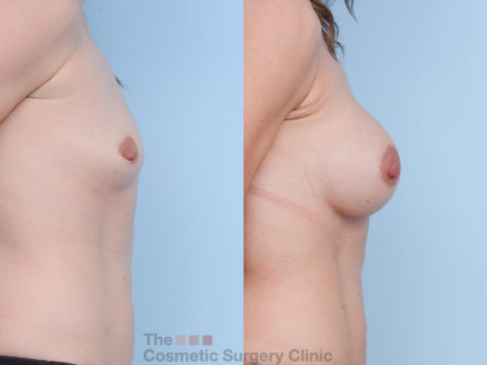 Before & After Breast Augmentation with Fat Grafting Case 502 View #5 View in Waterloo, Ontario
