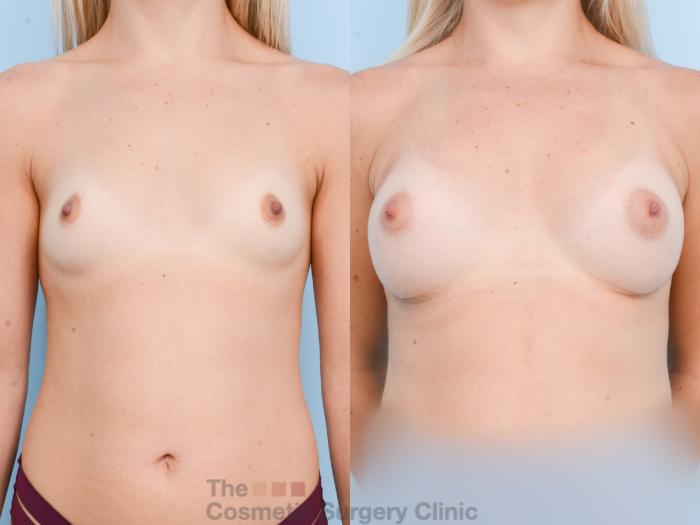 Before & After Breast Augmentation with Fat Grafting Case 801 Front View in Waterloo, Ontario