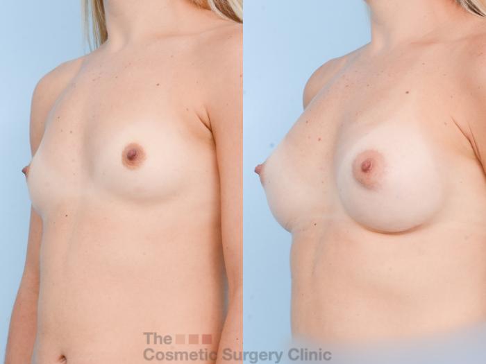 Before & After Breast Augmentation with Fat Grafting Case 801 Left Oblique View in Waterloo, Ontario