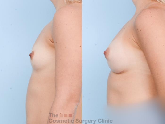 Before & After Breast Augmentation with Fat Grafting Case 801 Left Side View in Waterloo, Ontario