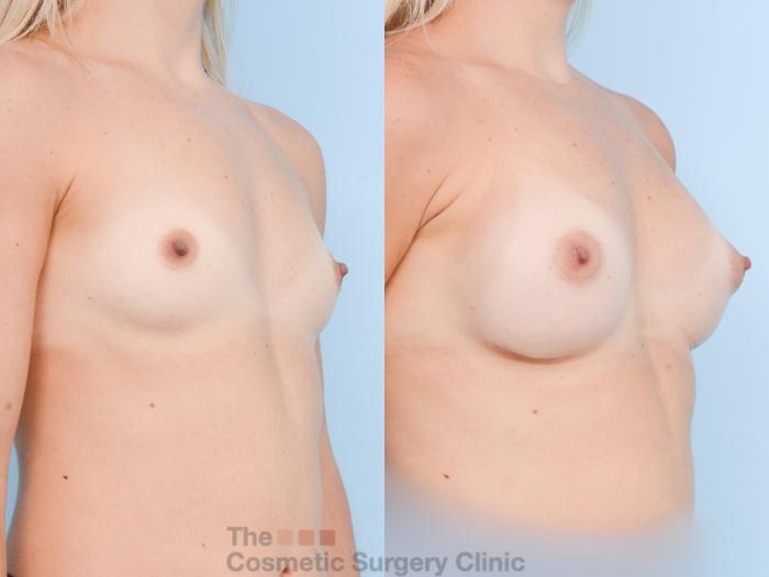 Before & After Breast Augmentation with Fat Grafting Case 801 Right Oblique View in Waterloo, Ontario