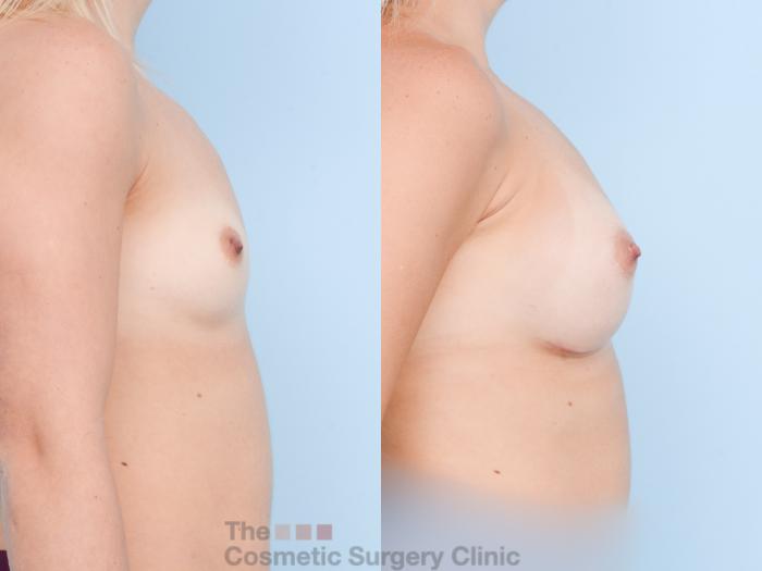 Before & After Breast Augmentation with Fat Grafting Case 801 Right Side View in Waterloo, Ontario