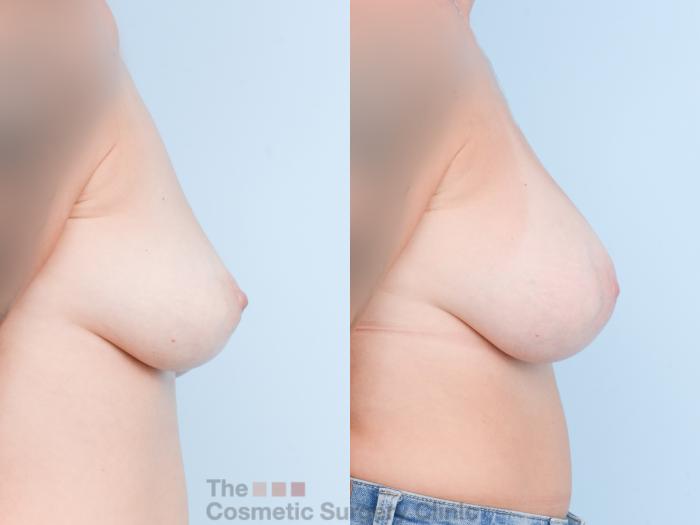 Before & After Breast Augmentation with Fat Grafting Case 871 Right Side View in Waterloo, Ontario