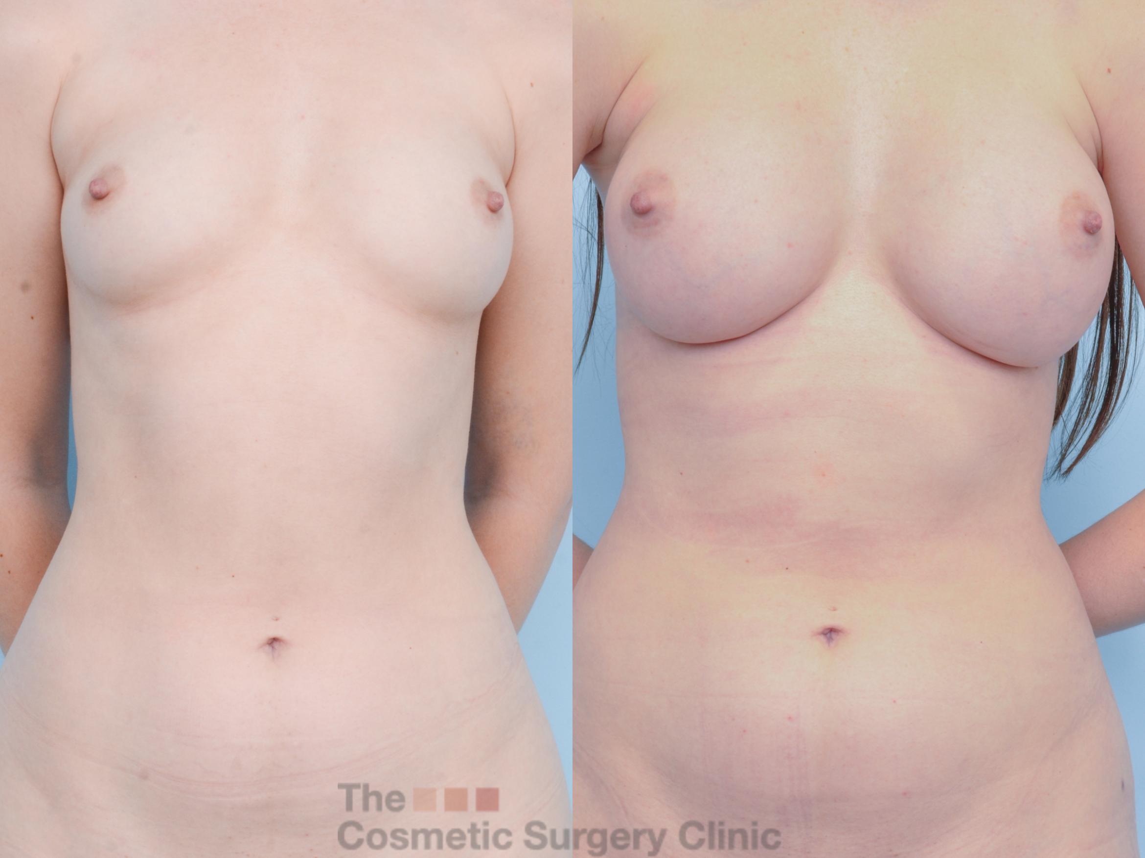 Before & After Breast Augmentation with Fat Grafting Case 881 Front View in Waterloo, Ontario