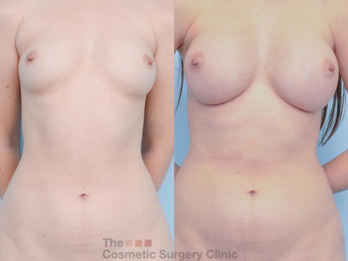 Before & After Breast Augmentation with Fat Grafting Case 881 Front View in Waterloo, Ontario