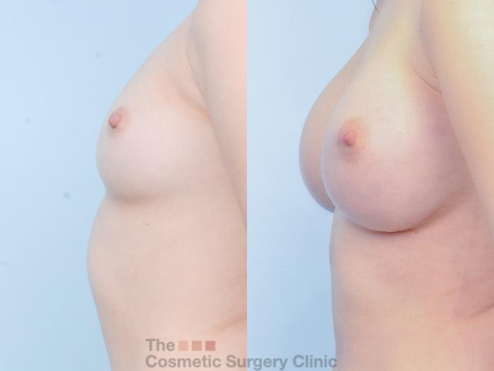Before & After Breast Augmentation with Fat Grafting Case 881 Left Side View in Waterloo, Ontario