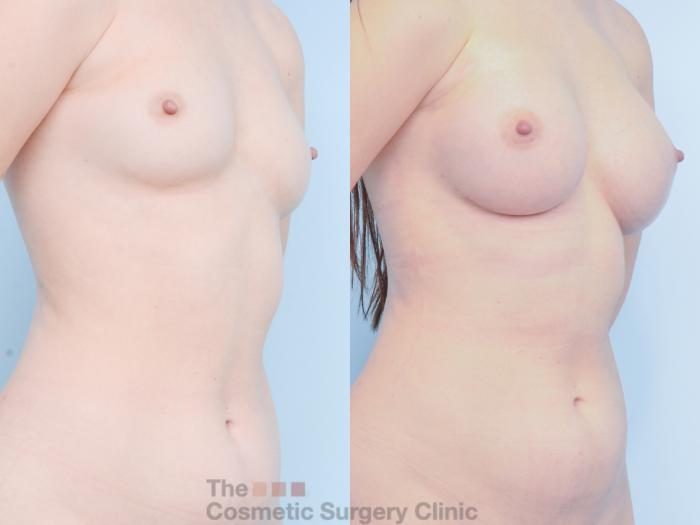 Before & After Breast Augmentation with Fat Grafting Case 881 Right Oblique View in Waterloo, Ontario