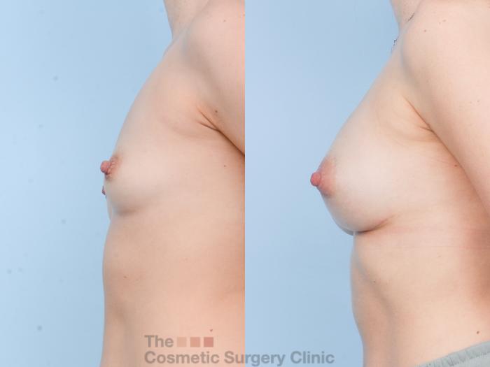 Before & After Breast Augmentation with Fat Grafting Case 901 Left Side View in Waterloo, Ontario