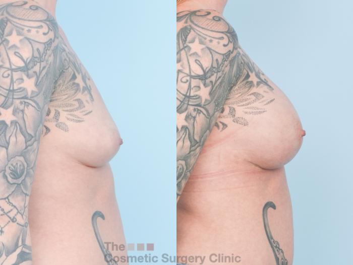 Before & After Breast Augmentation with Fat Grafting Case 909 Right Side View in Waterloo, Ontario
