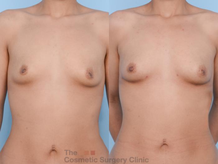 Before & After Breast Fat Grafting (No Implant) Case 402 View #2 View in Waterloo, Ontario