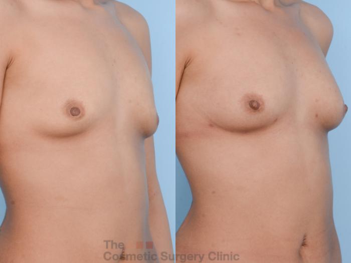 Before & After Breast Fat Grafting (No Implant) Case 402 View #3 View in Waterloo, Ontario