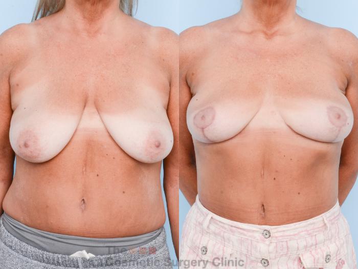 Before & After Breast Lift Case 818 Front View in Waterloo, Ontario